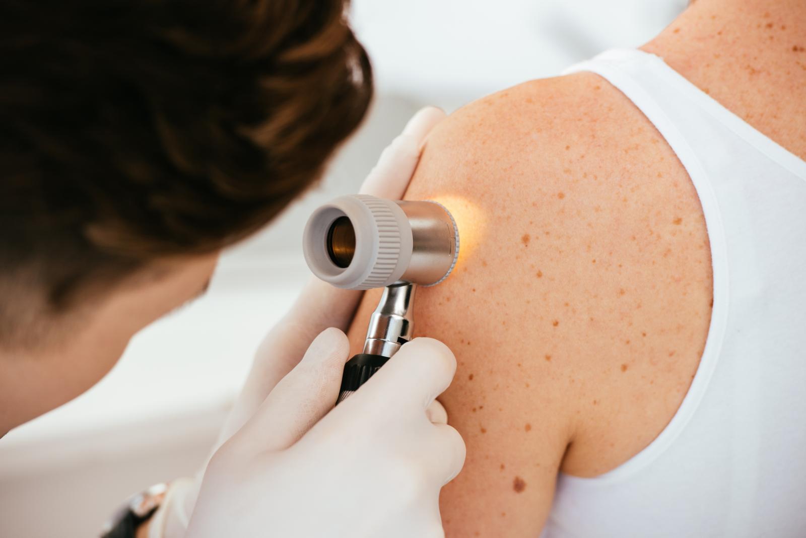 Melanoma Day e Dermatologia: le 10 regole d’oro per la salute della pelle